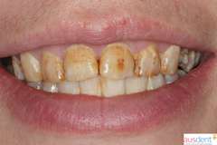 Флюорозное поражение зубов верхней челюсти