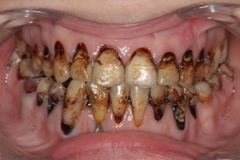 Кариозные  и некариозные поражения зубов верхней и нижней челюстей