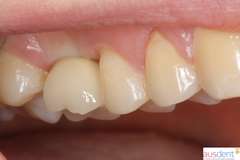 Окончательный вид протезирования зубов