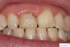 Неудовлетворительные пломбы на передних зубах