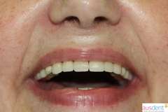 Окончательный вид протезирования зубов