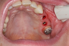состояние после имплантации через 6 месяцев, формирователи десны выкручены, на зуб 2.7 установлена культьевая вкладка
