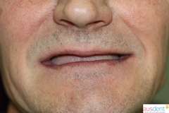 Полная адентия верхней и нижней челюсти (вид до протезирования зубов)