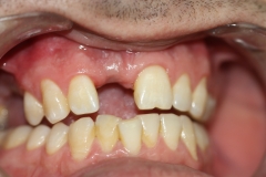 отсутствие переднего зуба (планируется установка имплантата)