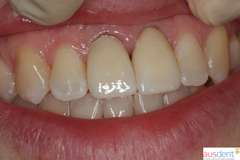 Окончательный вид протезирования зубов верхней челюсти коронками на основе диоксида циркония