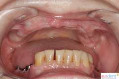 Полное отсутствие зубов верхней челюсти и частичное отсутствие зубов нижней челюсти