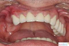 Вид до протезирования зубов