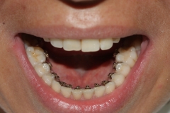 брекеты изготавливаются индивидуально для каждого зуба