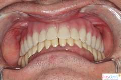 Окончательный вид протезирования в полости рта (нижние металлокерамические протезы подлежат замене)