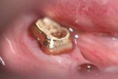 во рту, на зуб, установлена золотая культевая вкладка