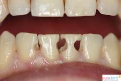 Зубы нижней челюсти отпрепарированы