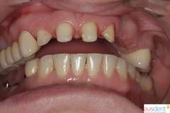 Фронтальная группа зубов отпрепарирована под коронки на основе диоксида циркония