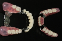 слева (металлокерамический мост и замковый бюгельный протез верхней челюсти), справа (кламерный бюгельный протез нижней челюсти)