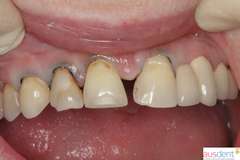 Неудовлетворительная реставрация зубов верхней челюсти пломбировочным материалом
