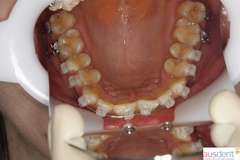 Вид сапфировых брекетов на верхней челюсти зубов