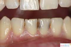 Тотальное кариозое поражение зубов в области нижней челюсти