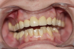 было сделано: нижняя челюсть - реставрация зубов композитными материалами, верхняя челюсть - восстановление с помощью металлокерамических коронок