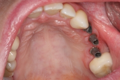 на имплантаты прикручены титановые абатменты, на зуб 2.7 установлена металлокерамическая коронка