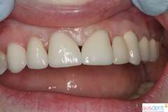 Окончательный вид протезирования зубов на основе диоксида циркония
