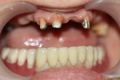 металлокерамичекие коронки фиксированы на зубы, на них одет бюгельный съёмный протез на замках