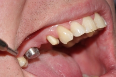 зубы отпрепарированы под металлокерамический протез