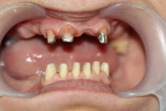 оставшиеся зубы отпрепарированы под металлокерамические коронки