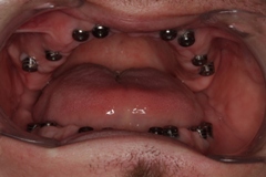 Отсутствие зубов верхней и нижней челюстей. Установка 16 имплантатов Alpha Bio