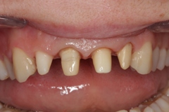 Вкладки из диоксида циркония на четрых передних зубах