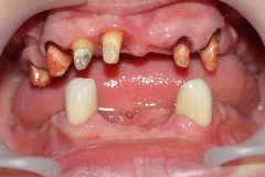 на нижней челюсти установленны 2 металлокерамические коронки, на верхней зубы подготовлены под металлокерамические коронки с аттачменами(замками)