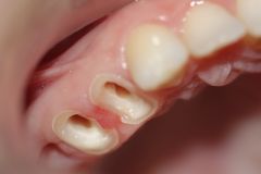 корневые каналы зубов отпрепарированы под культевые вкладки