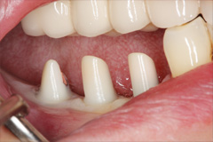 Абатменты на основе диоксида циркония, зафиксированные в полости рта